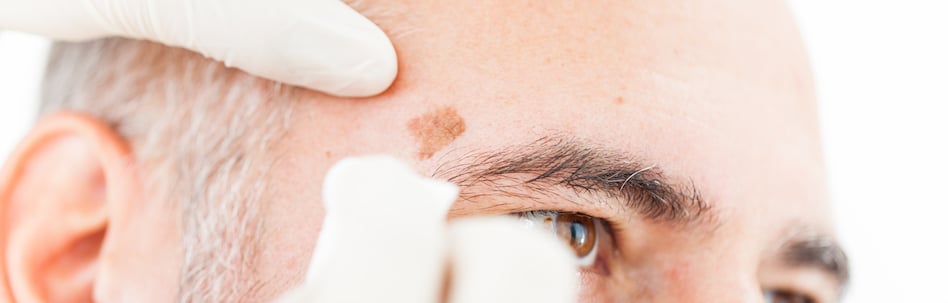 image of a man with actinic keratosis on his forehead