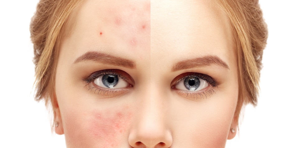 rosacea