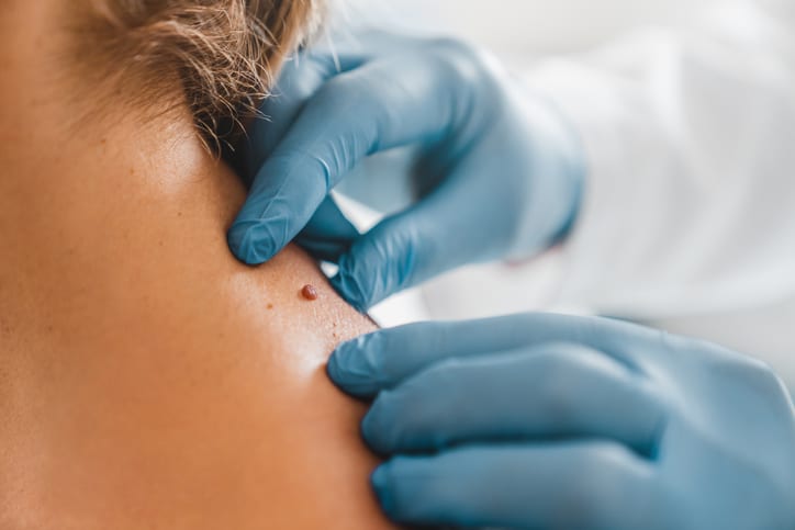 Close up of dermatologist examining patient birthmark in clinic