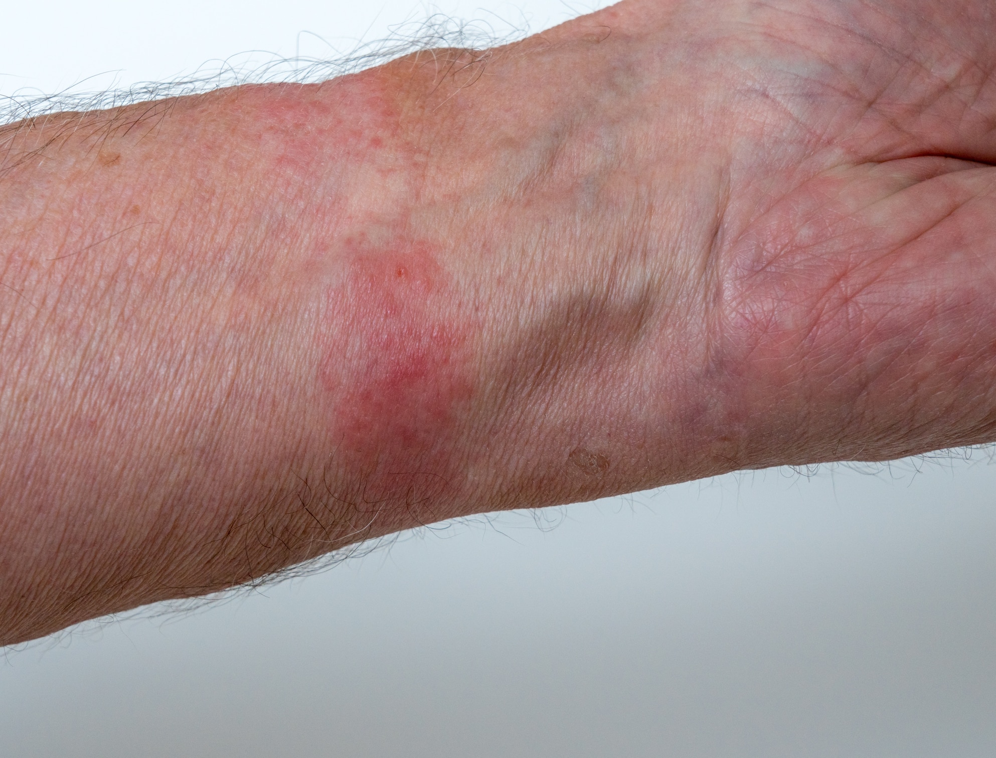 Contact Dermatitis