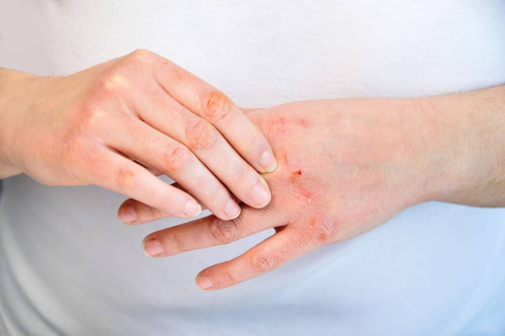 Dermatitis