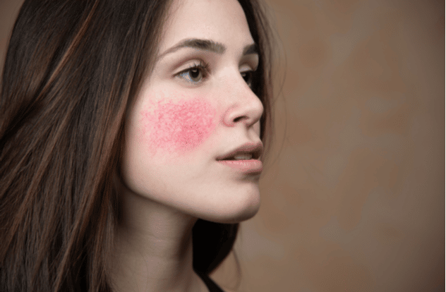 Beautiful young woman with rosacea