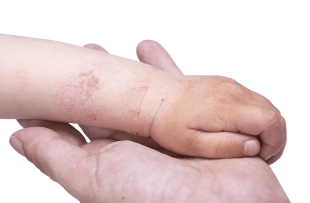 Eczema on the skin of the kids hand