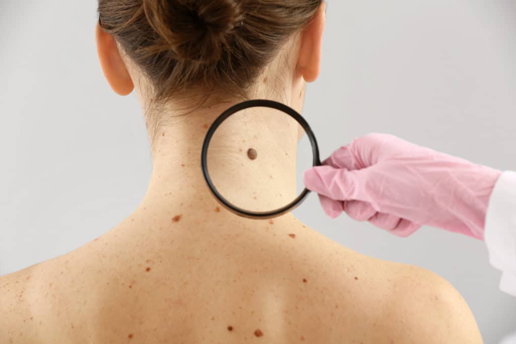 Skin cancer mole mohs surgery