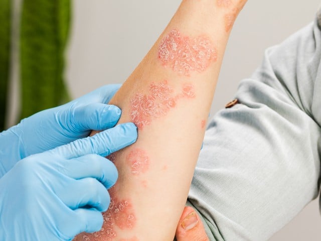 A dermatologist wearing gloves examines the skin of a sick patient