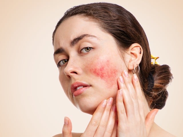 Caucasian woman who frowns and shows reddened and inflamed cheeks