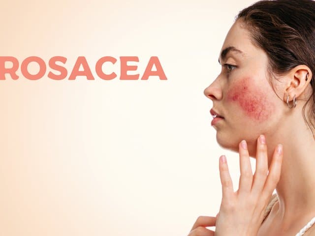 woman with inflamed blood vessels on her cheeks and encrypted ROSACEA word