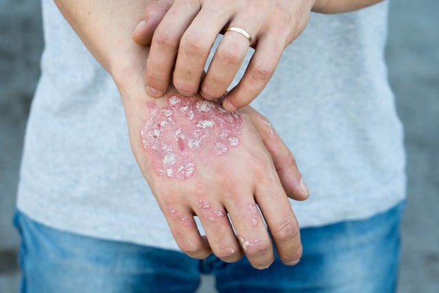 psoriasis awareness month (