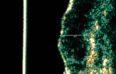 Fraction8 ultrasound