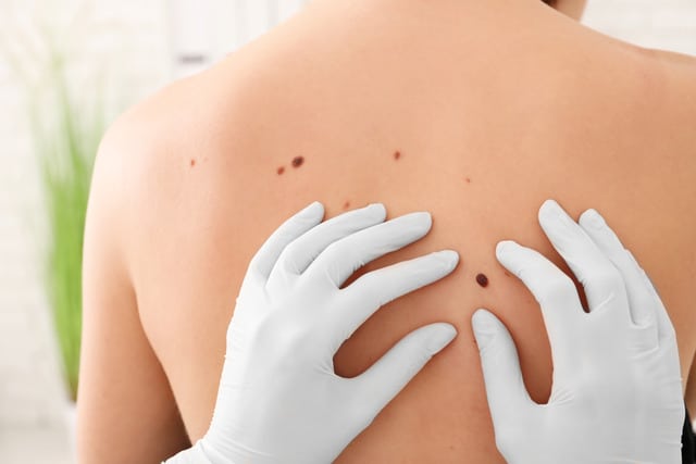 Skin cancer treatment (1)