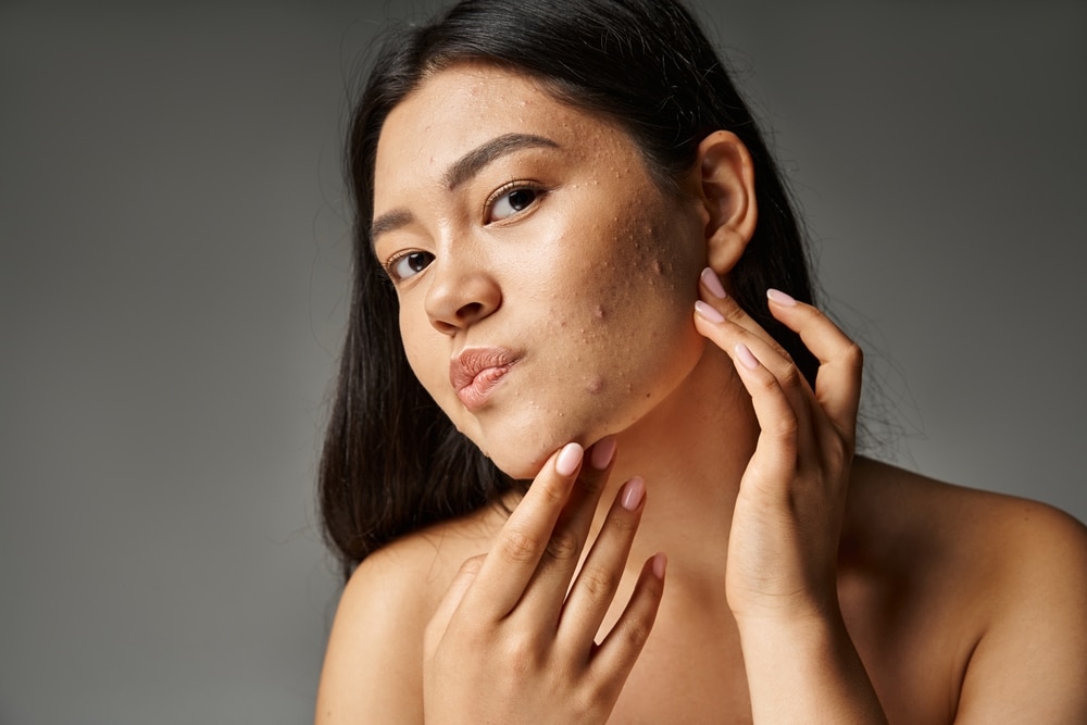 A woman looking at acne on her cheek