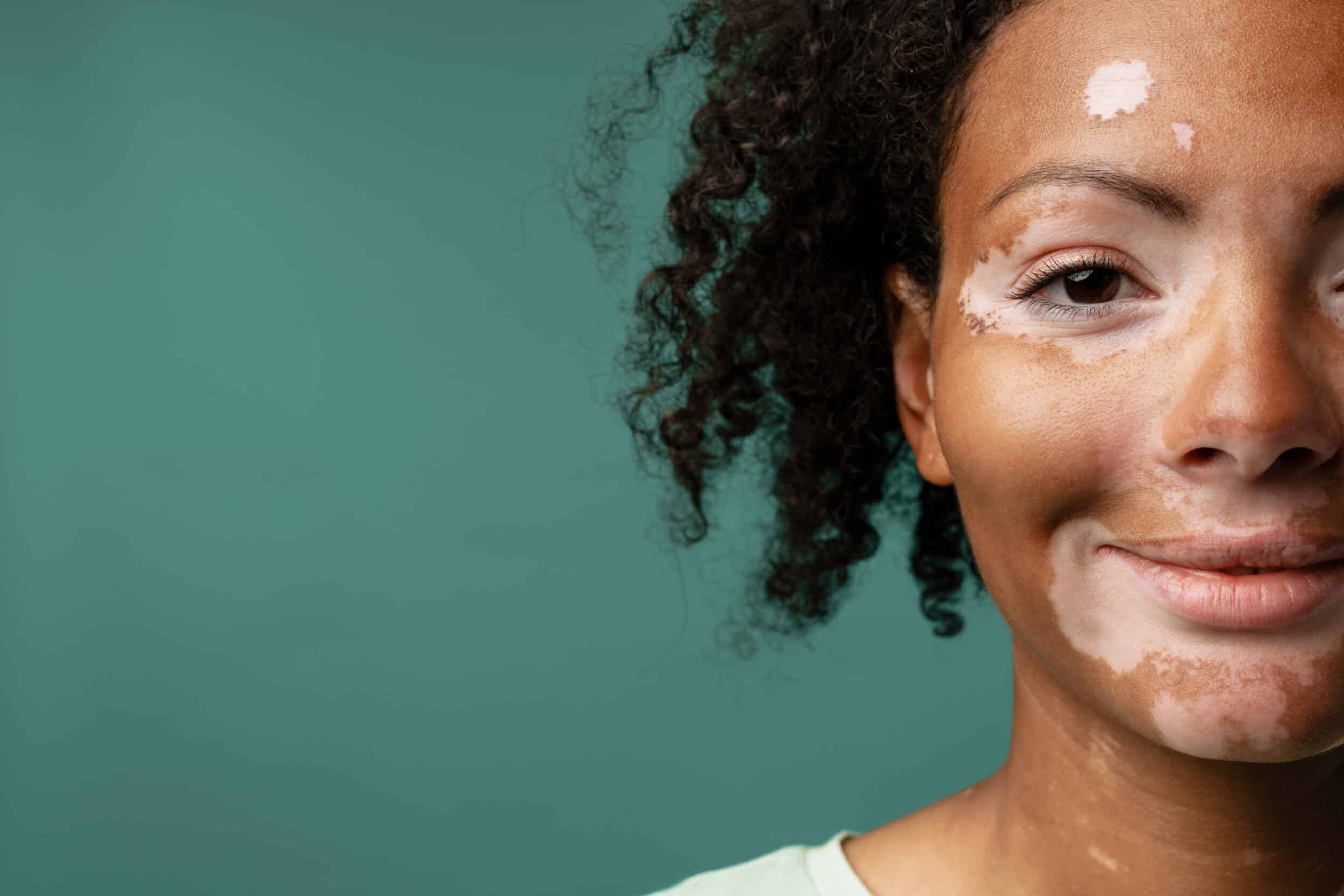 A woman with vitiligo on her face