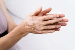 Vitiligo on a woman's hands