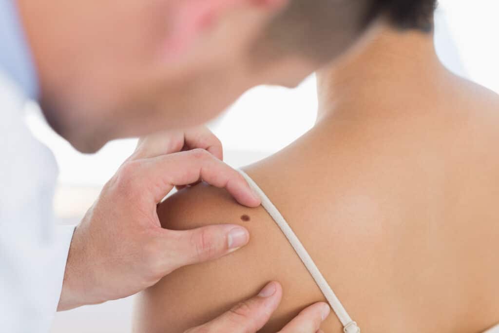 A dermatologist examining skin cancer on a patient’s back