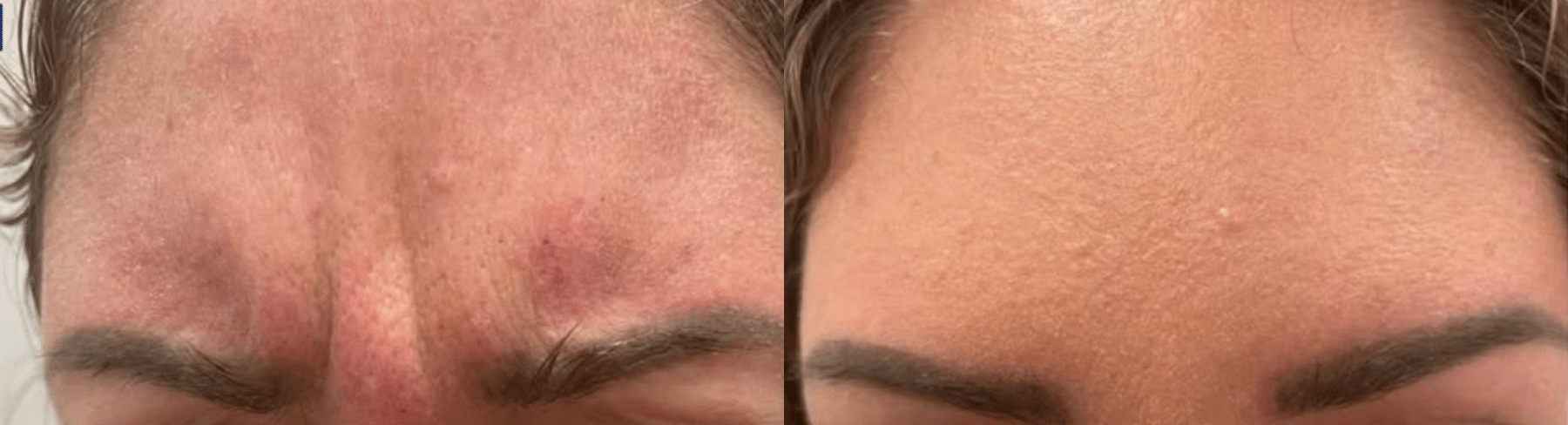 Before and After Image: Botox - front