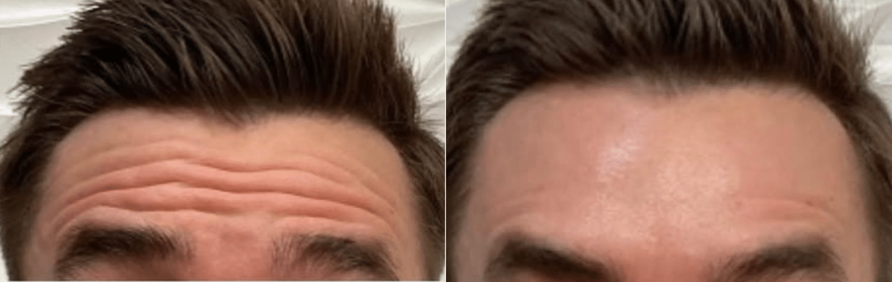 Before and After Image: Botox - front