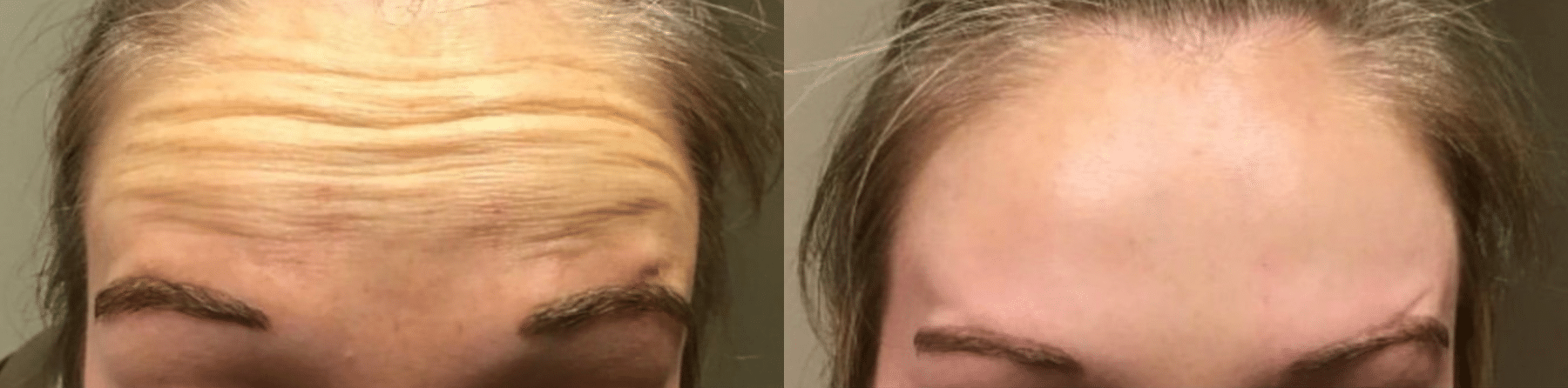 Before and After Image: Botox - front