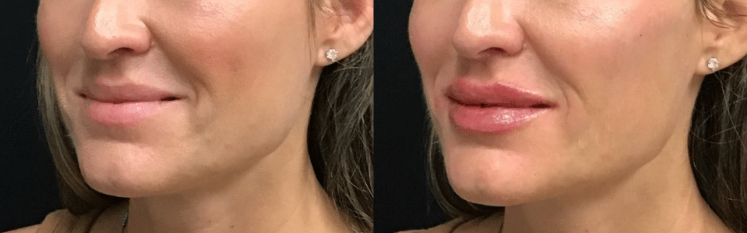 Before and After Image: Fillers - left-front-oblique