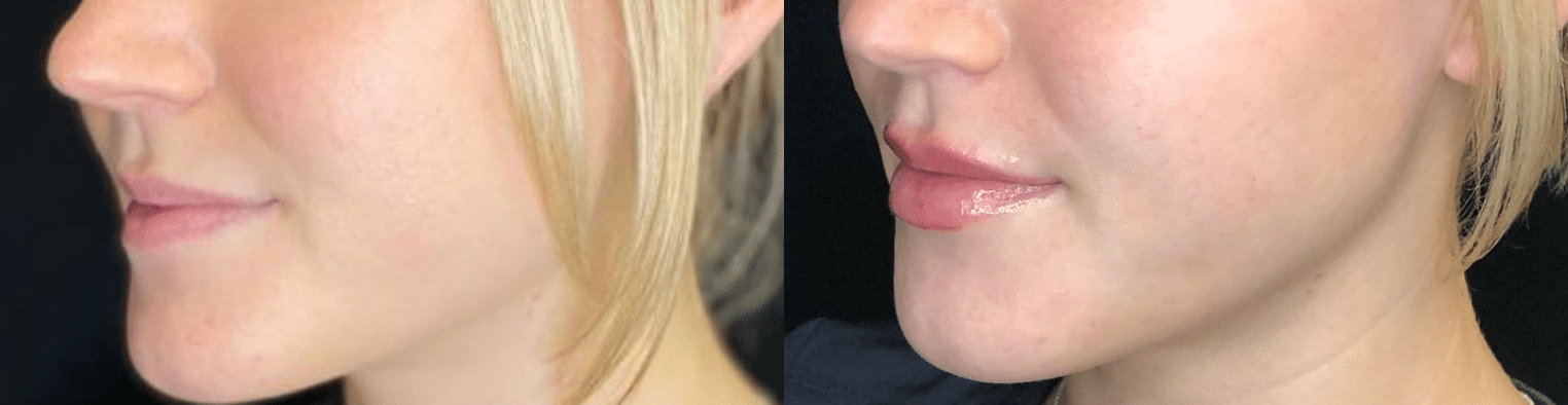 Before and After Image: Fillers - left-side