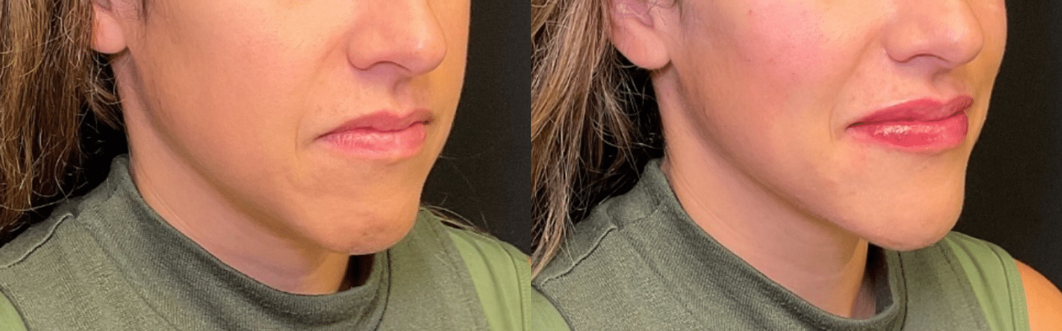 Before and After Image: Fillers - right-front-oblique