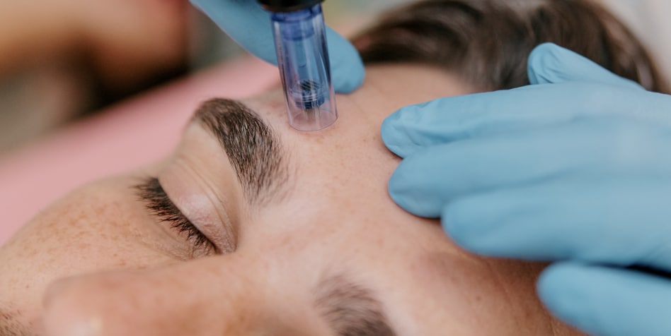 Procedure of induction therapy with microneedles and collagen on the face of a European man close up