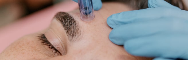 Procedure of induction therapy with microneedles and collagen on the face of a European man close up