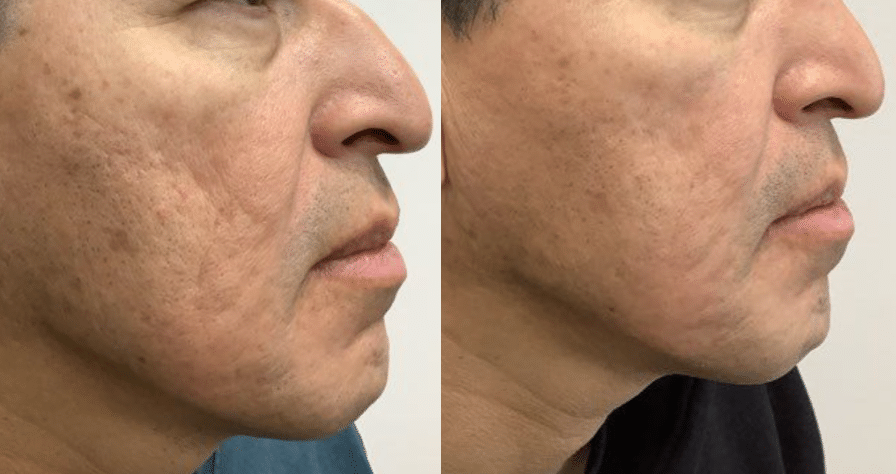 Before and After Image: Microneedling - front