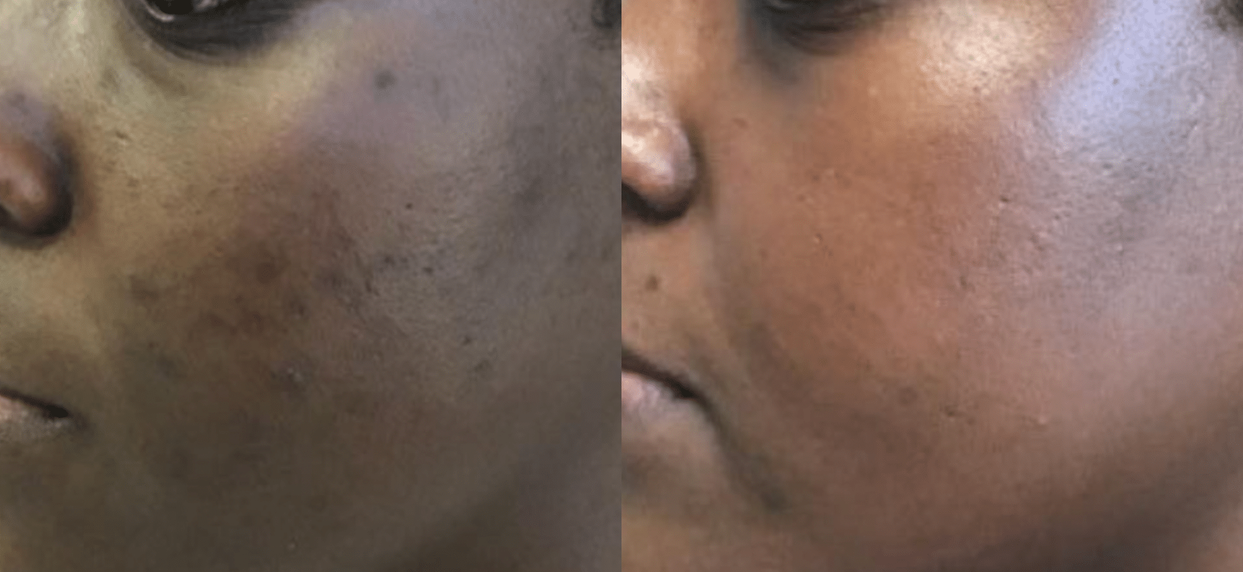 Before and After Image: Microneedling - left-front-oblique