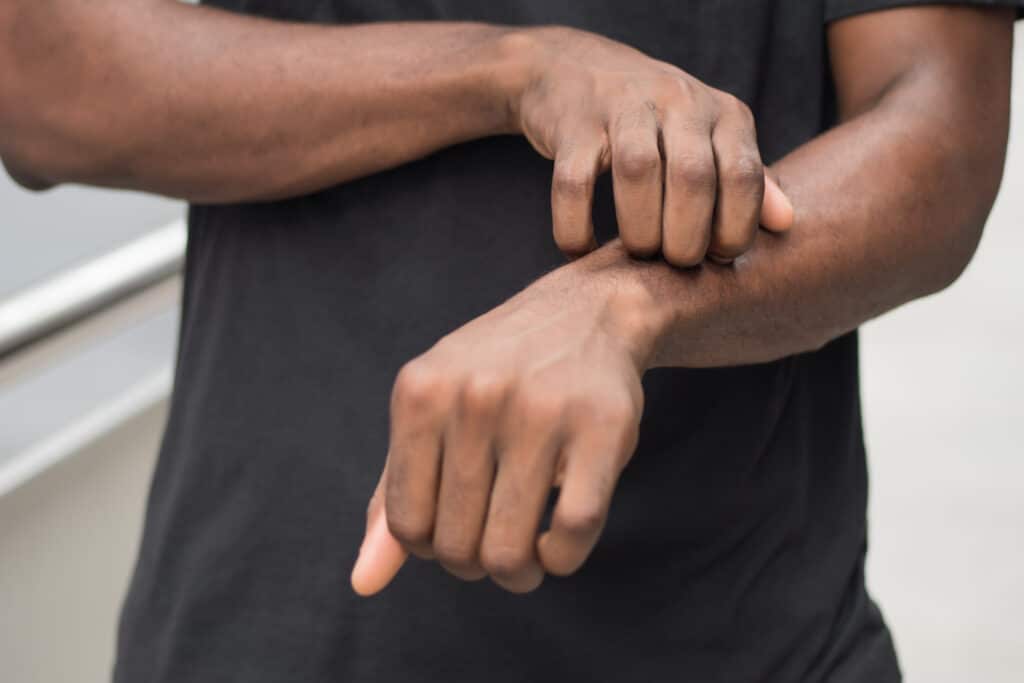A close-up shot of a man with eczema scratching his arms
