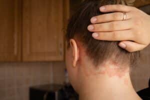 A close-up shot of psoriasis on the back of a woman's neck