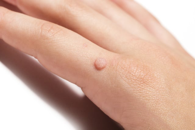 4 Common Types of Warts and How to Identify Them